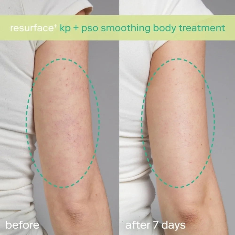 🆕 SKINFIX Resurface+ KP & Psoriasis Smoothing Treatment Body Lotion 150mL NIB